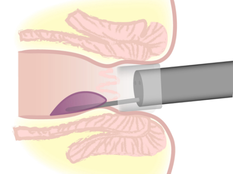痔疮内镜下硬化治疗术 帮助痔疮患者摆脱痛苦
