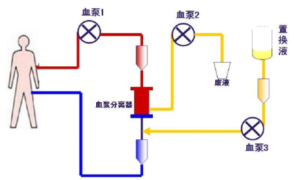 血浆置换，换出新生活